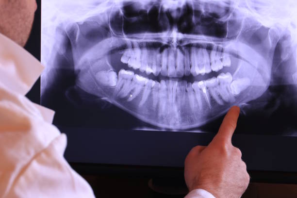 Best Emergency Wisdom Teeth Removal in Middletown, CA