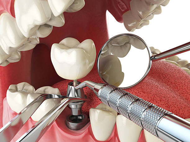 Best Emergency Wisdom Teeth Removal in Middletown, CA